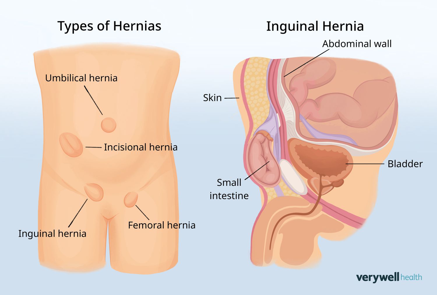 Treating Hernia Types and Managing Pain (1)